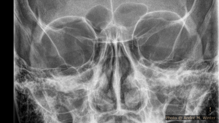 Schleimlösende Medikamente und ihre triviale Umwegwirkung