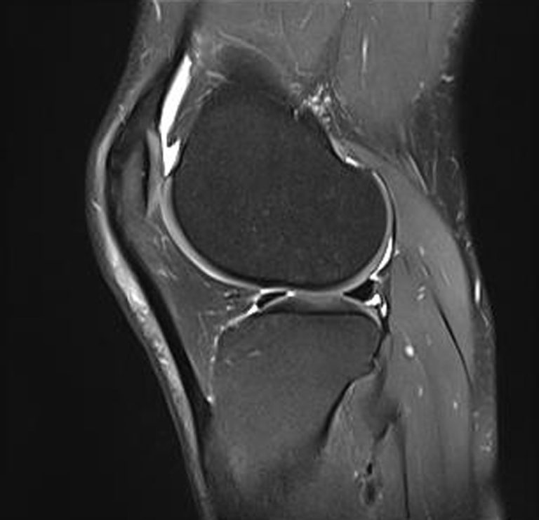 Knie MRT seitlich
