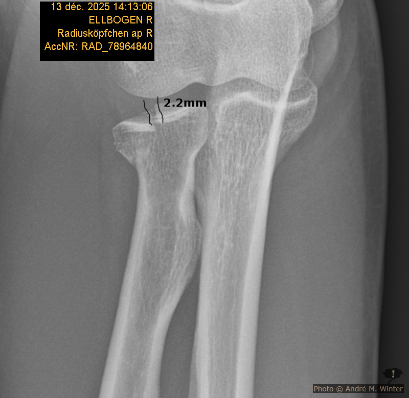 Röntgen Ellbogen am Tag des Unfalls