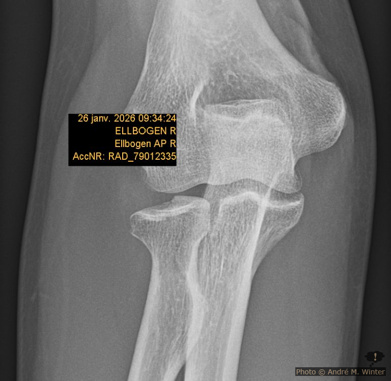 Röntgen Ellbogen nach fünf Wochen nach dem Unfall