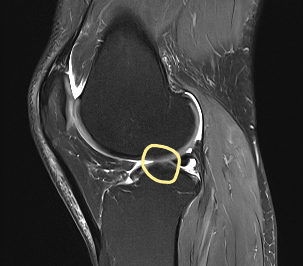 Knie-MRR 18. Februar 2026