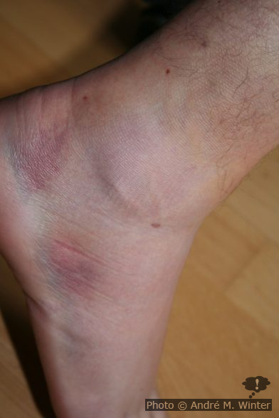 André mit geprellten Aussenknöchel