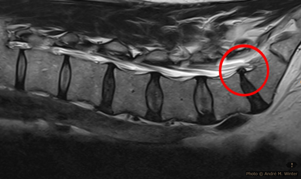 MRT Lendenwirbel mit Bandscheibenvorfall